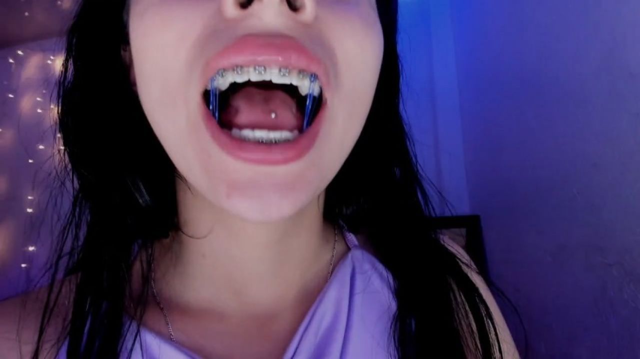 playing with the rubber bands of my braces