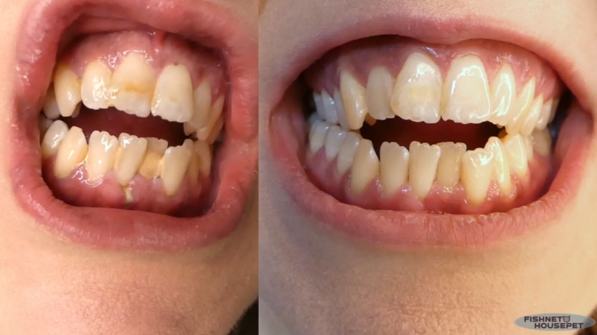 Before and After Dental Hygienist
