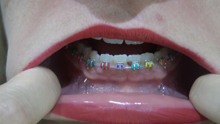 Extreme closeup POV of my braces