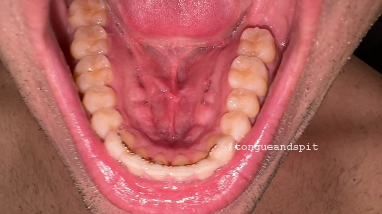 Andrew Mouth and Lower Teeth Part16 Video1