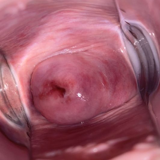 cervix close up 87 photos uterus