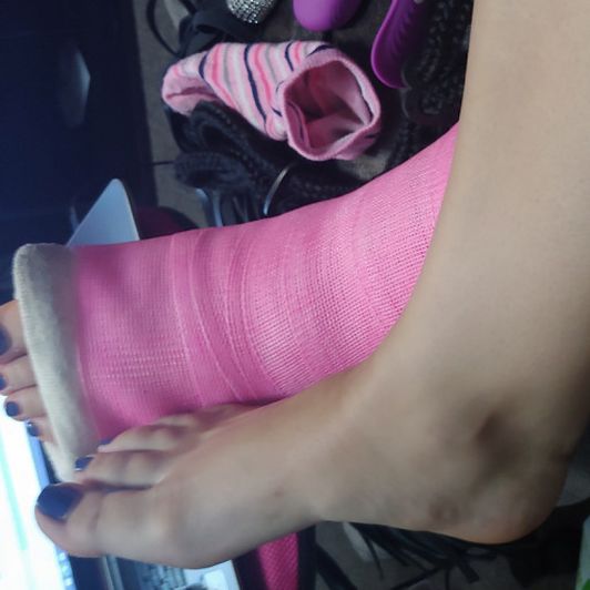 My pink short leg cast