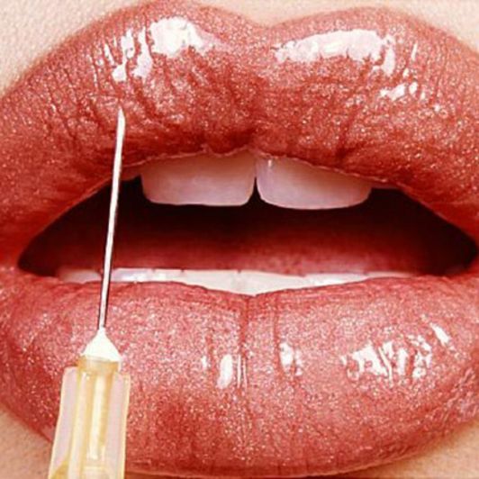 1mL Juvederm Syringe: Lips