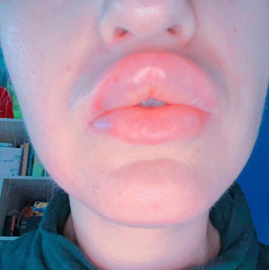Lip Fillers Donation Target for BIG LIPS