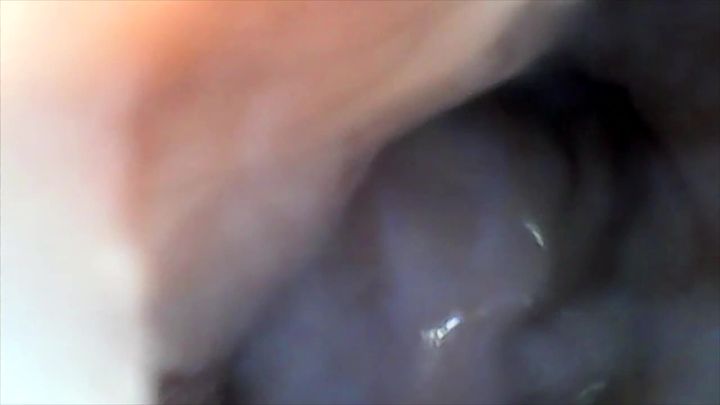 custom: internal cervix video