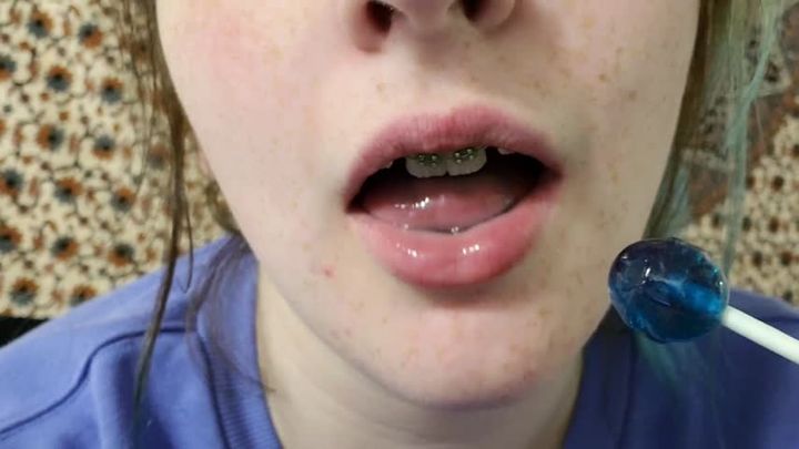 Oral Fixation With Braces + Freckles