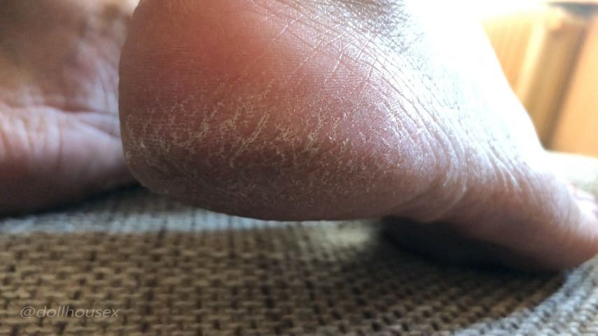 Dry Dirty Rough Feet And Soles Closeup