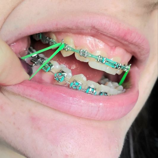 Full Set Of Braces Photoset