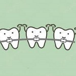Braces