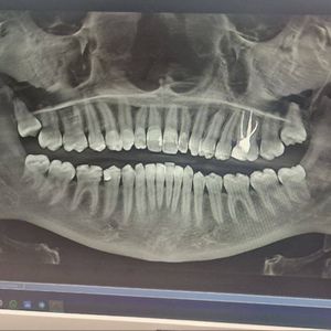 1 of 14 teeth treatment support!