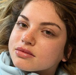 hyaluronic acid for my lips and nose