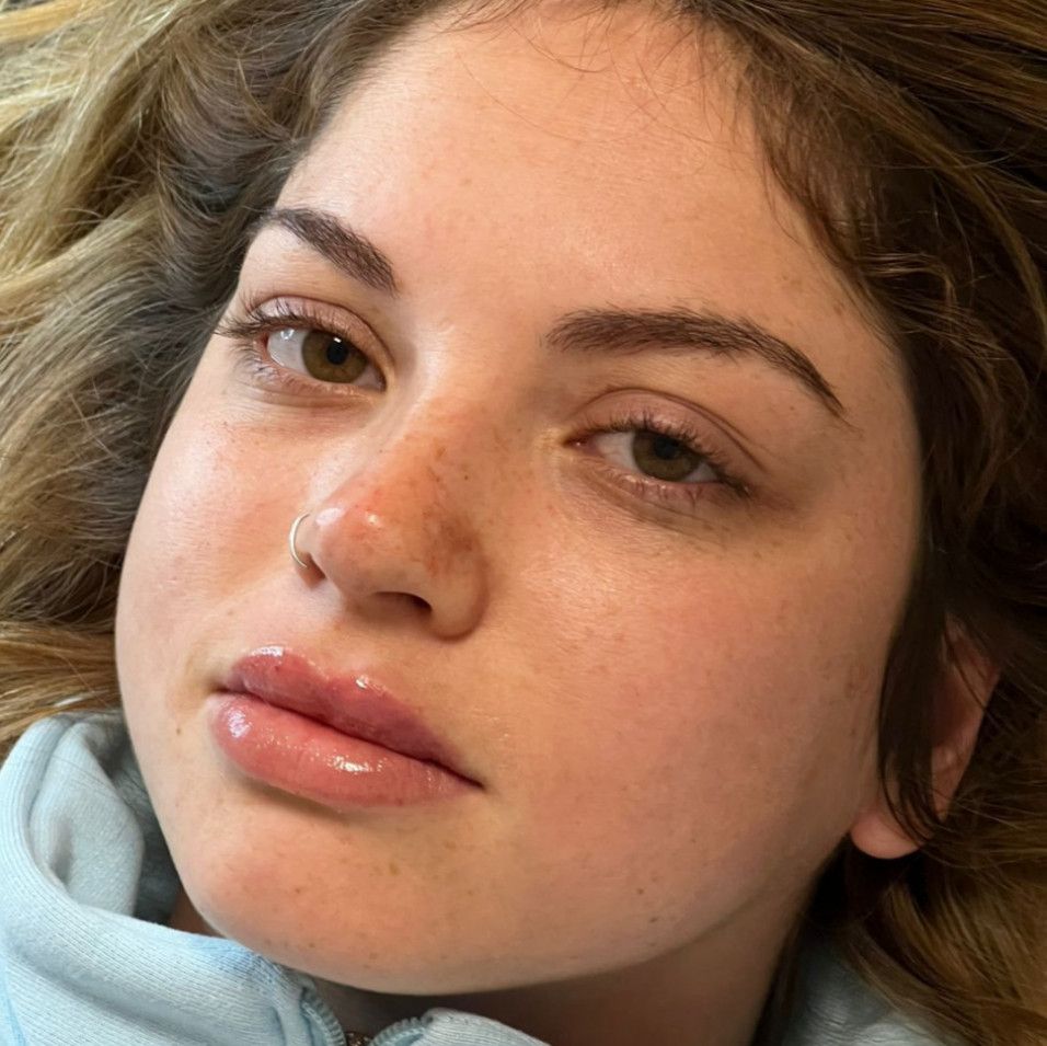 hyaluronic acid for my lips and nose