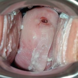 108 Cervix Pics