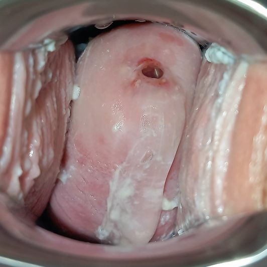 108 Cervix Pics