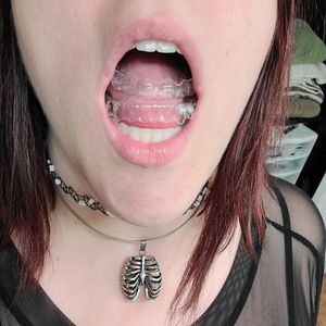 Buy my Invisalign Braces!
