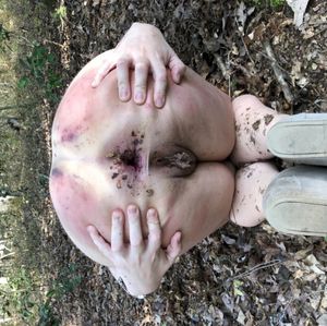 Anal gape
