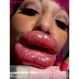 38 Fresh Lip Injection Pics From 10 7 2025