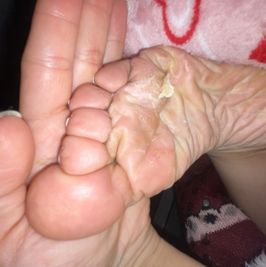 Di888 dry crusty feet pictures