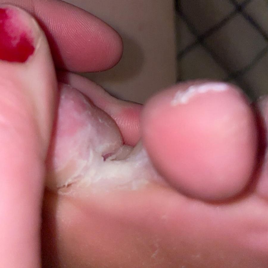 TexasWildflower itchy feet and socks 12 pictures