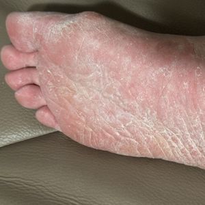 Simplytiffany eczema itchy soles 1