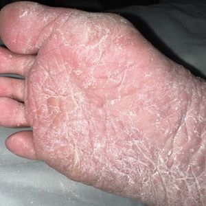 Simplytiffany eczema soles 2