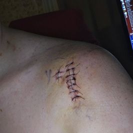 Donation after Surgery