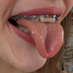 Close Up Braces Pics