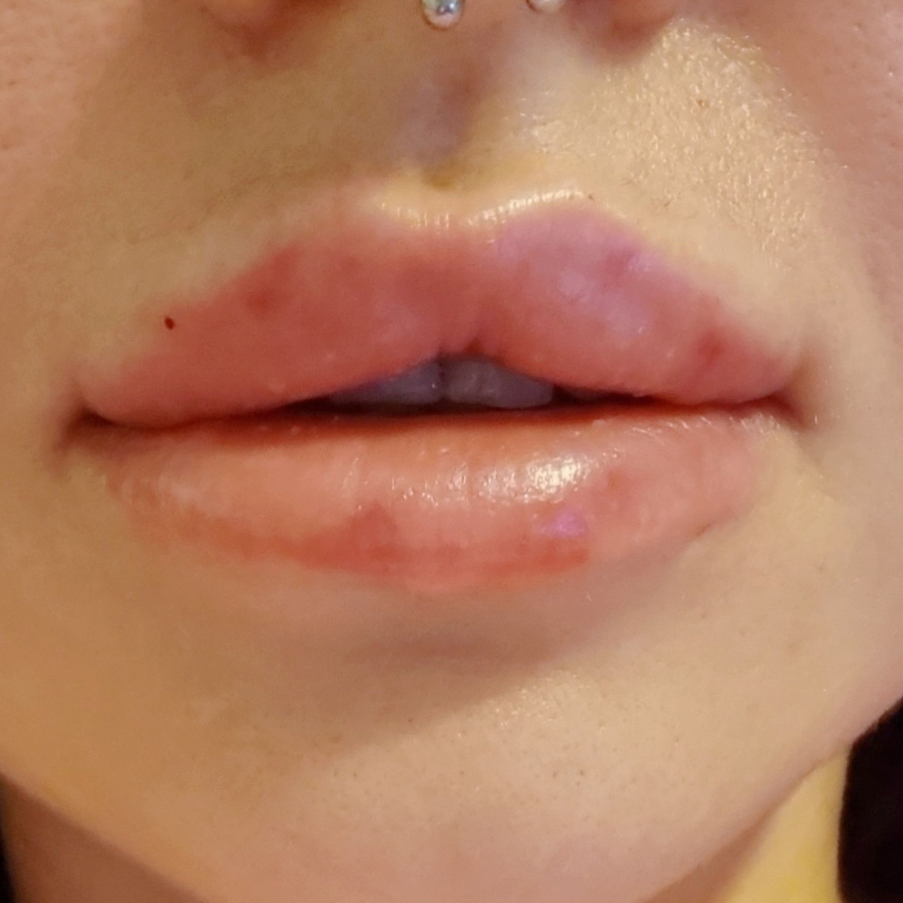 Bimbo Lips Fund