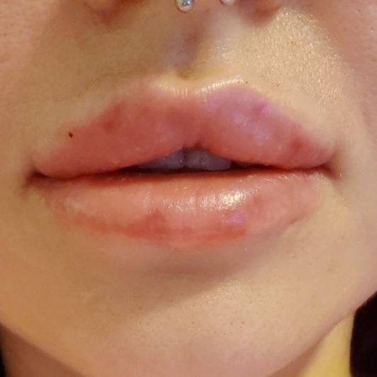 Bimbo Lips Fund