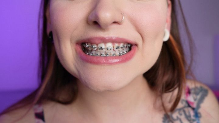 Braces Mouth Tour