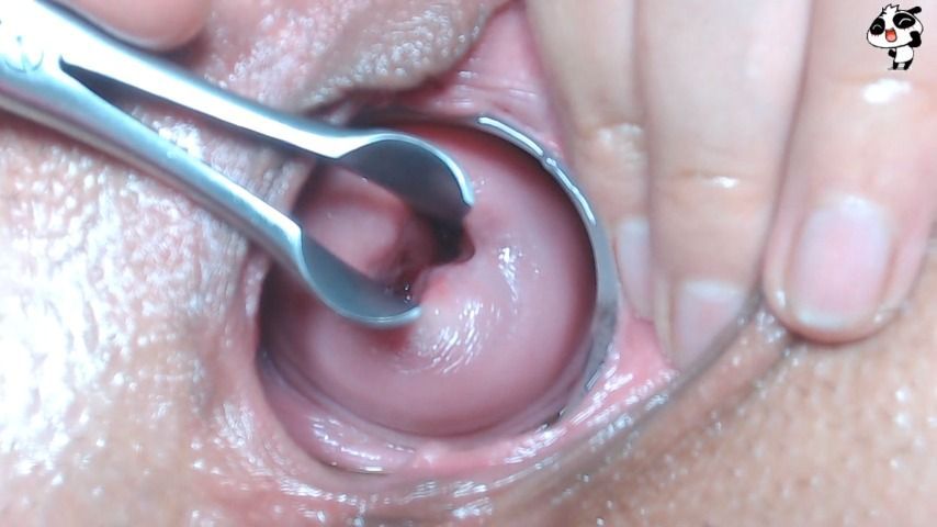 Andrada - Wide open cervix