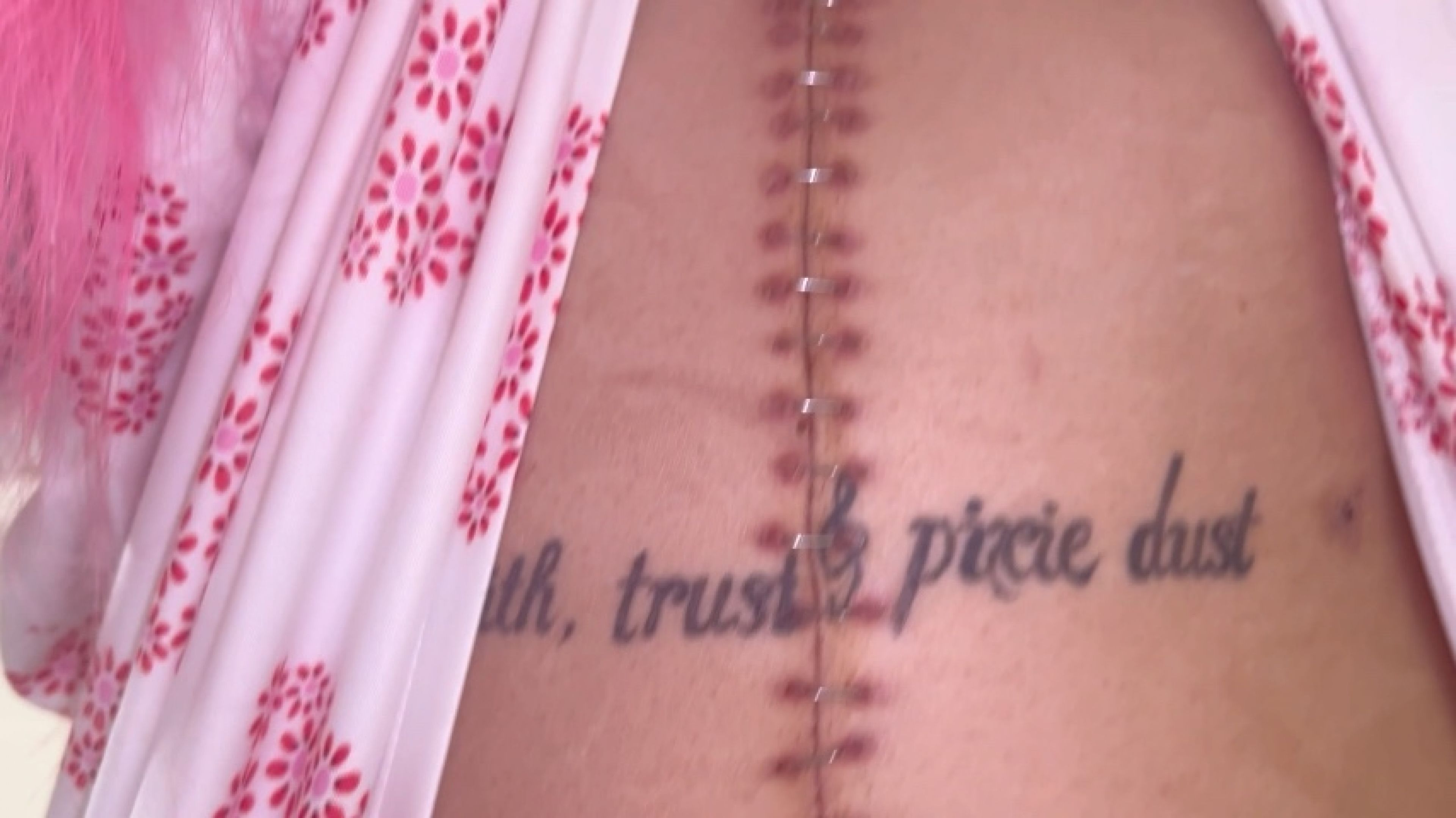 Belly Staples Removal After 2 Surgeries From A Car Accident