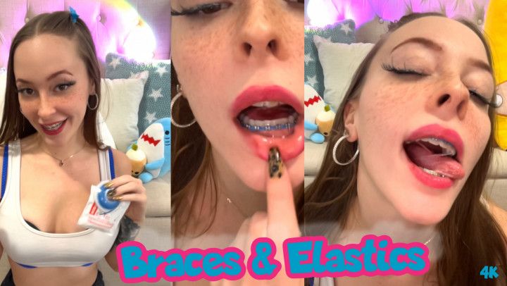 Braces , Elastics And Eating