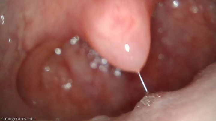 uvula endoscopy &amp; metal chopsticks