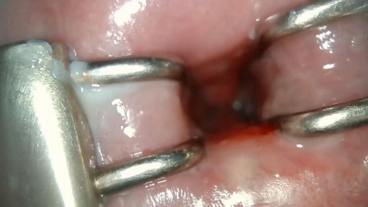 endocervical endoscopy