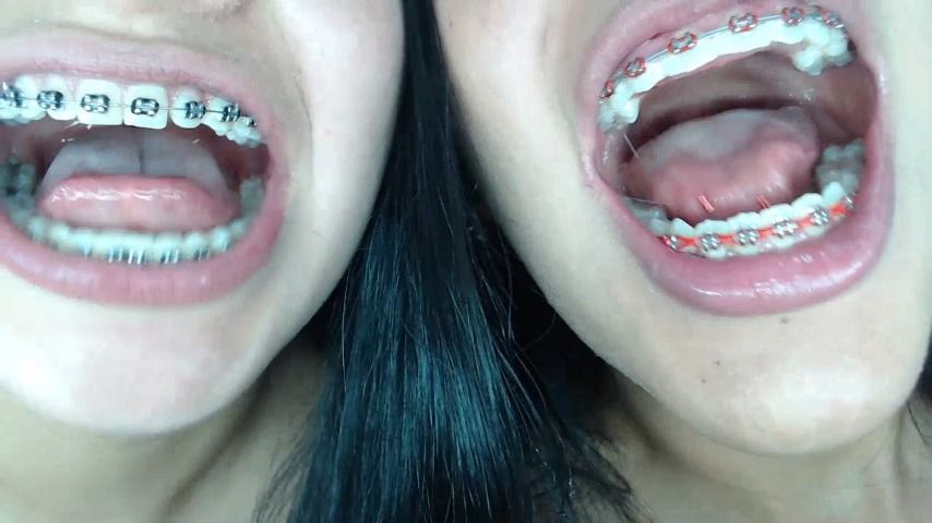 Braces, mouth, uvula fetish