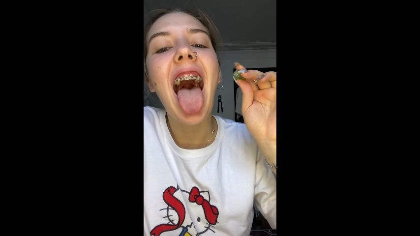 Metal braces VS Gummy