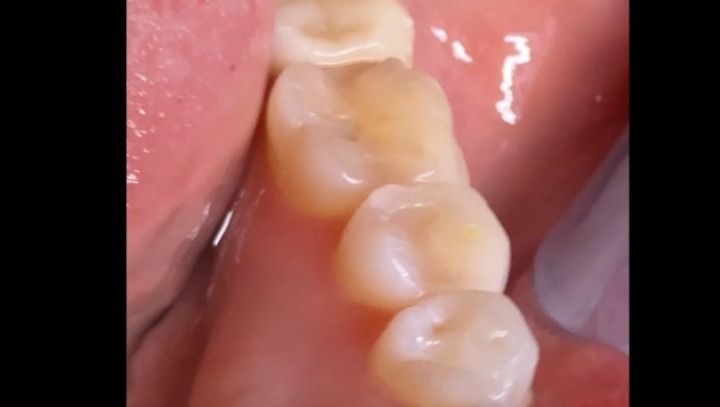 Teeth Tour