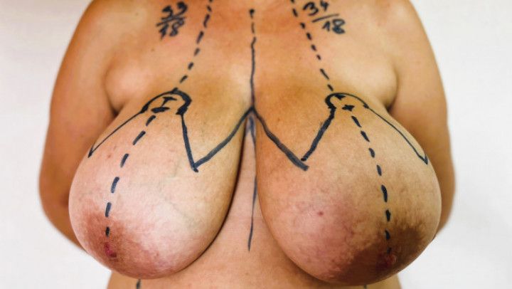 Breast reduction consultation - part 2 - Markings