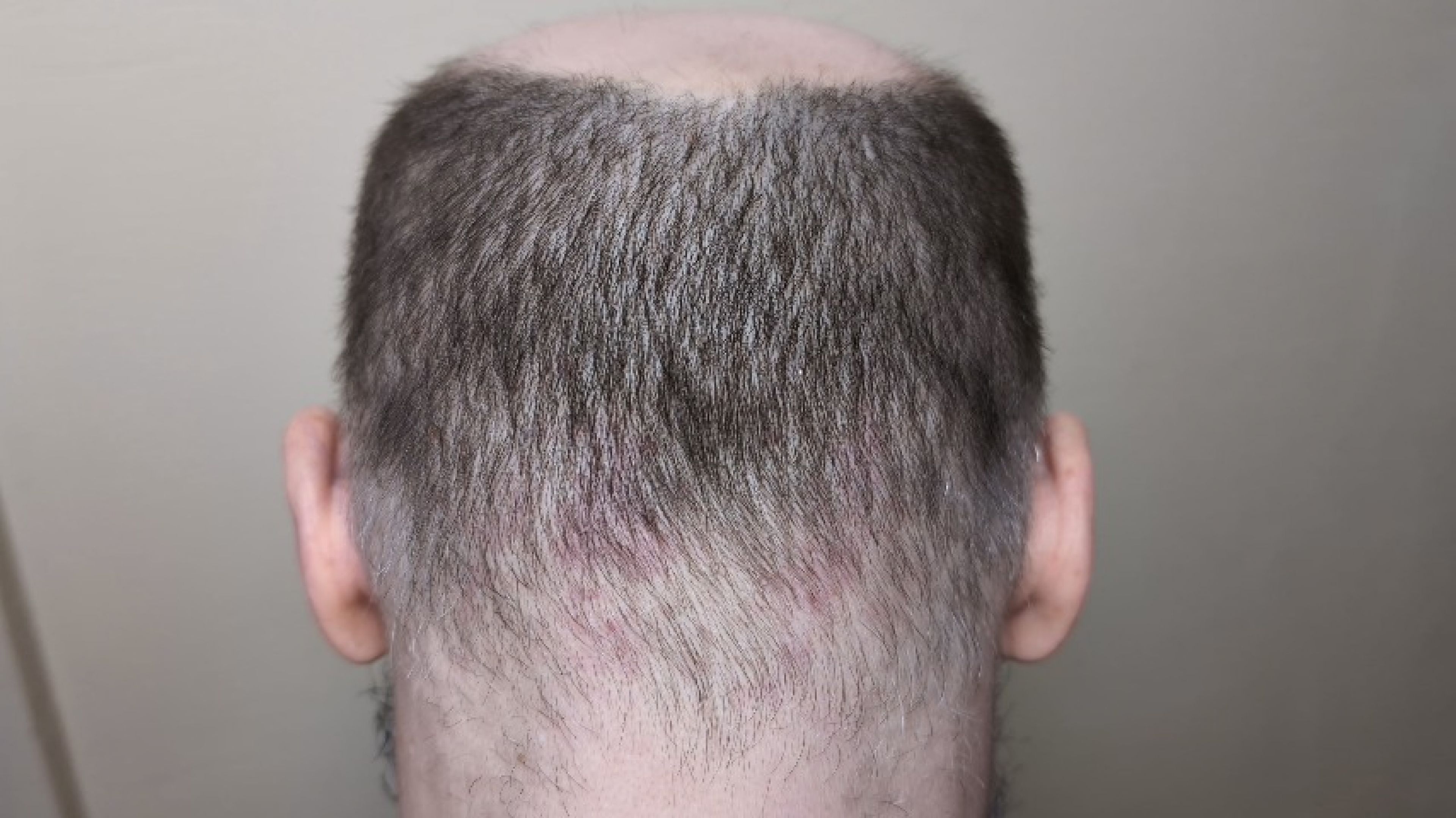 Going Straight to Skin I shave off His Head Completely Bald