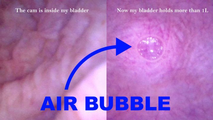 POV Endoscope Catheter Bladder Inflation
