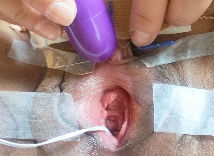 I inserted an acupuncture needle into the clitoris and stimu