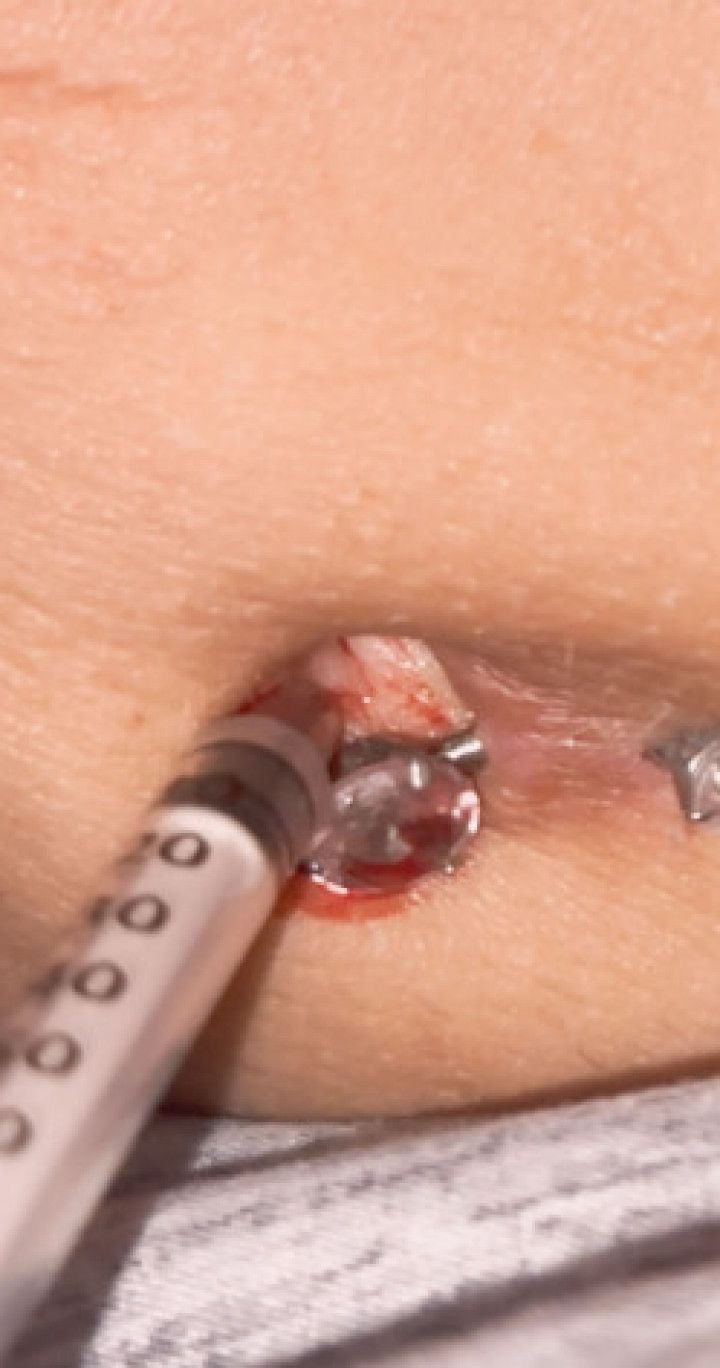 Extreme belly button pain with a needle
