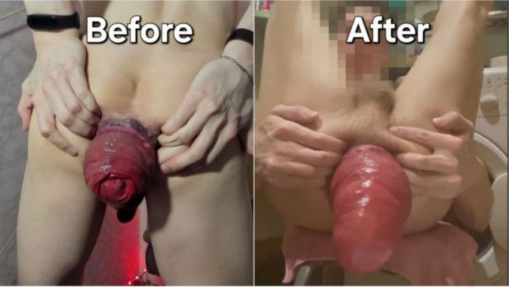 My personal method of developing anal prolapse