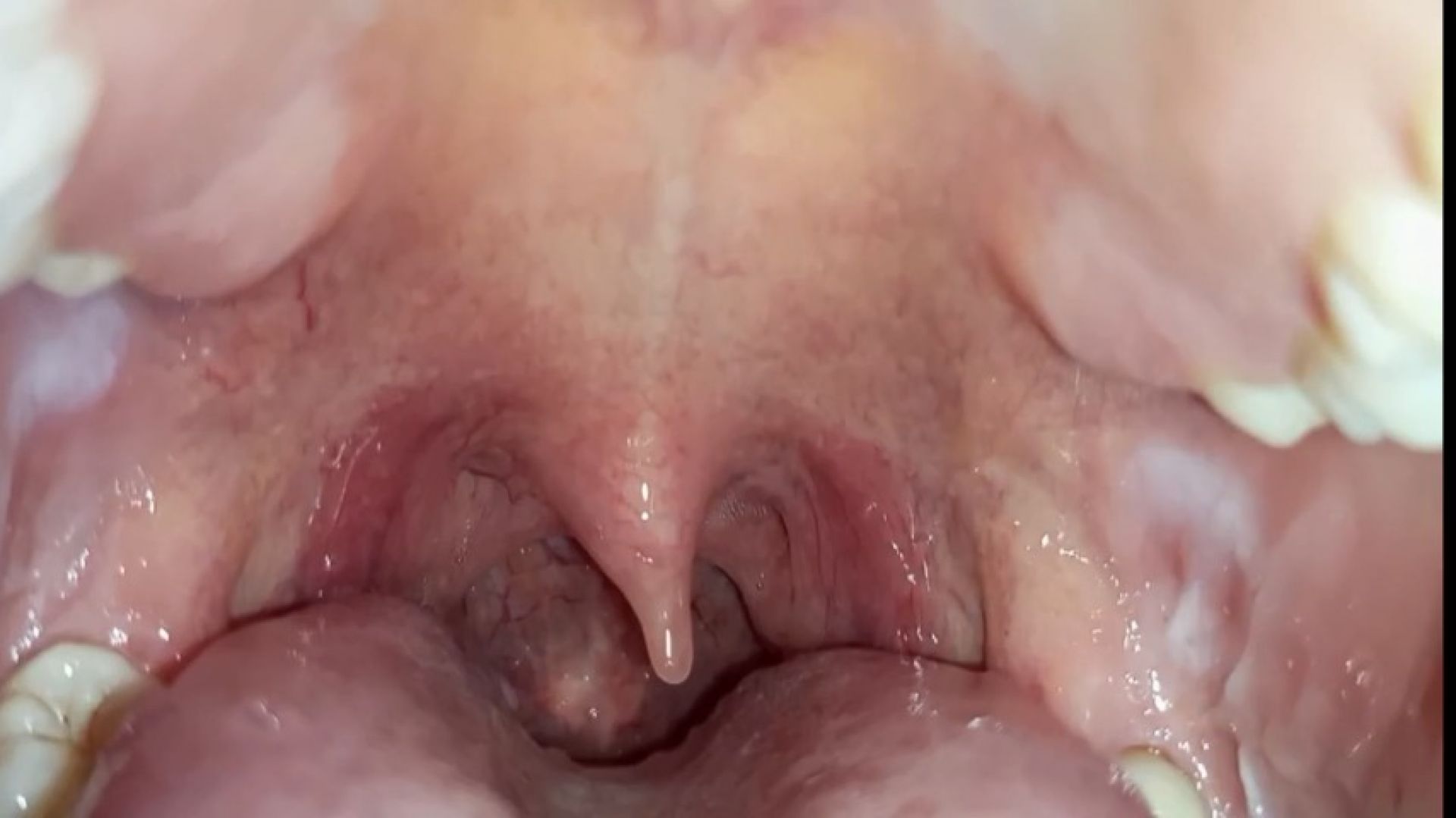 Open Mouth with Visible Uvula