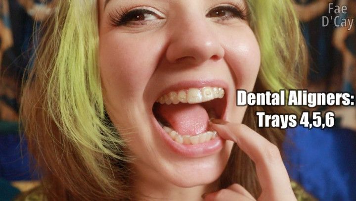 Dental Aligners : Tray 4,5,6